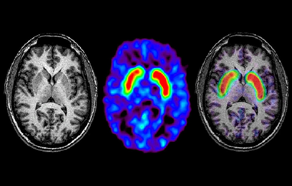 Detecting Parkinson Disease using ML Techniques